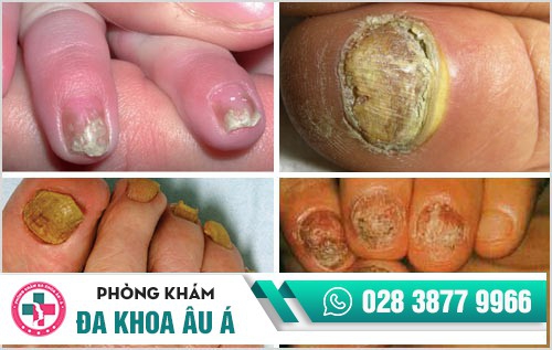 nguyên nhân gây nấm móng